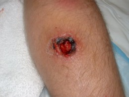 staph infection